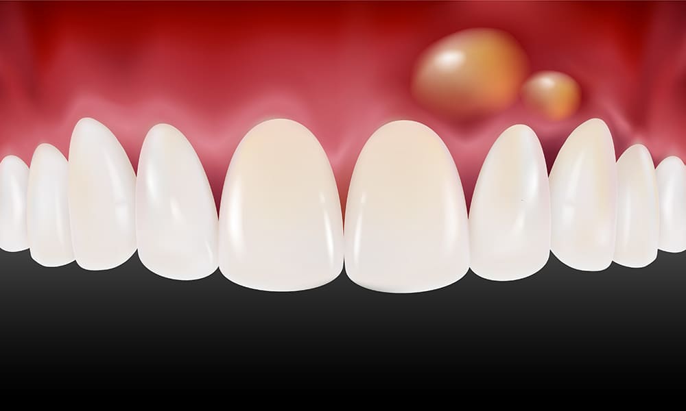 歯の根の先端の病気を治して歯を残す「歯根端切除術」
