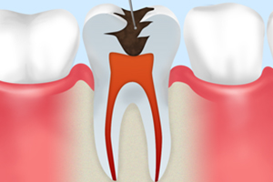歯質と神経の除去