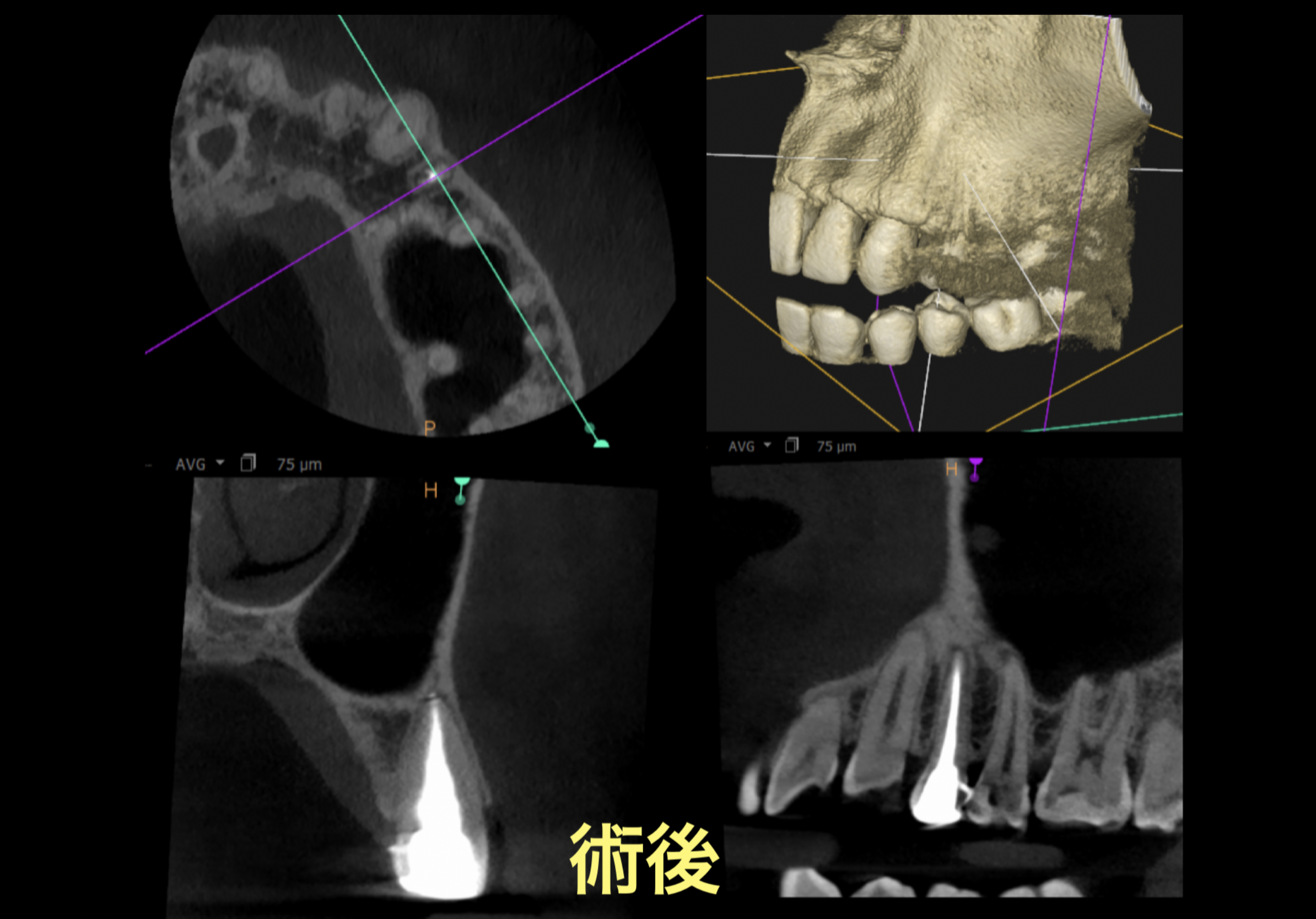 #14(左上4番) 再根管治療　4.27