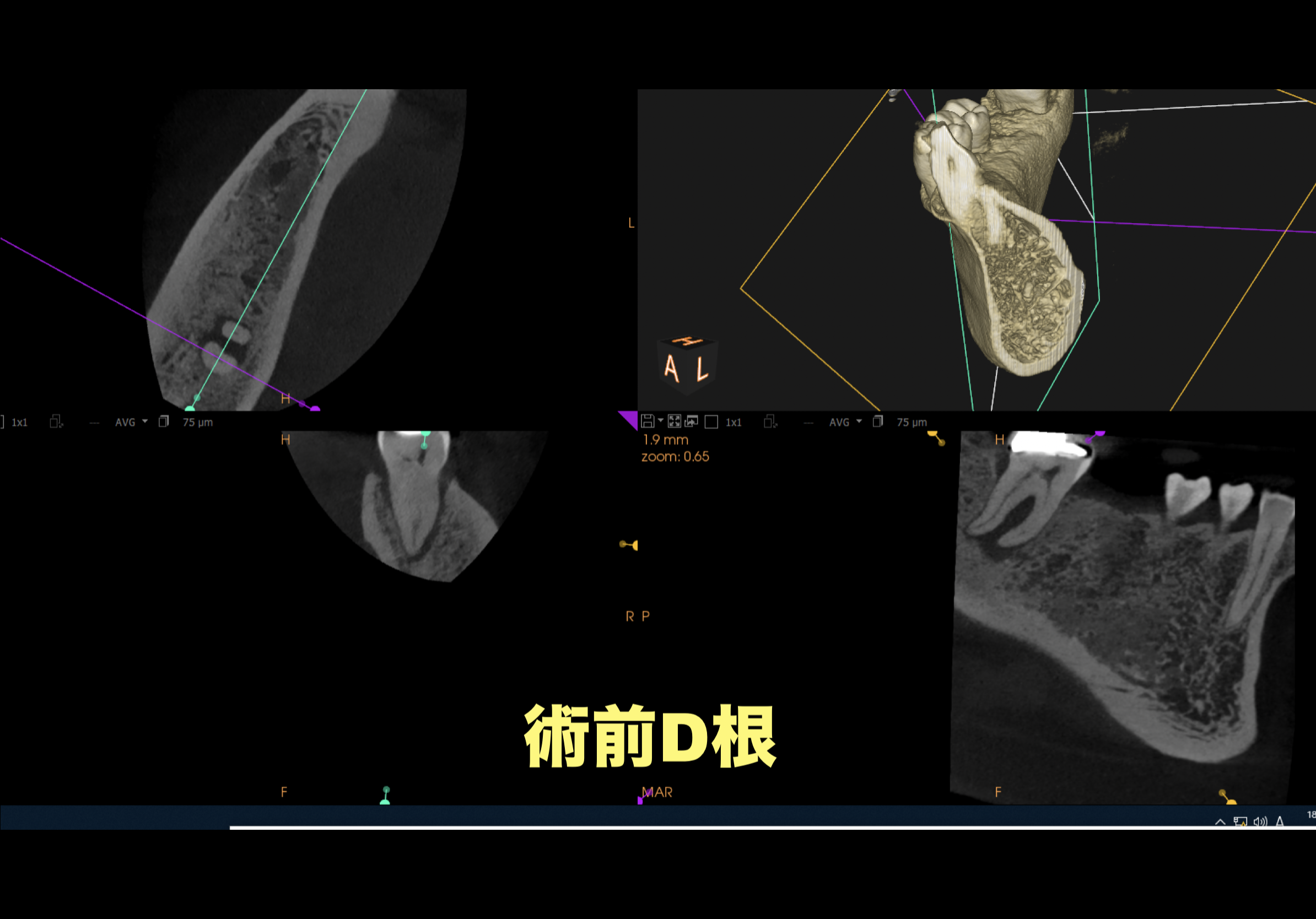 術前CT D根