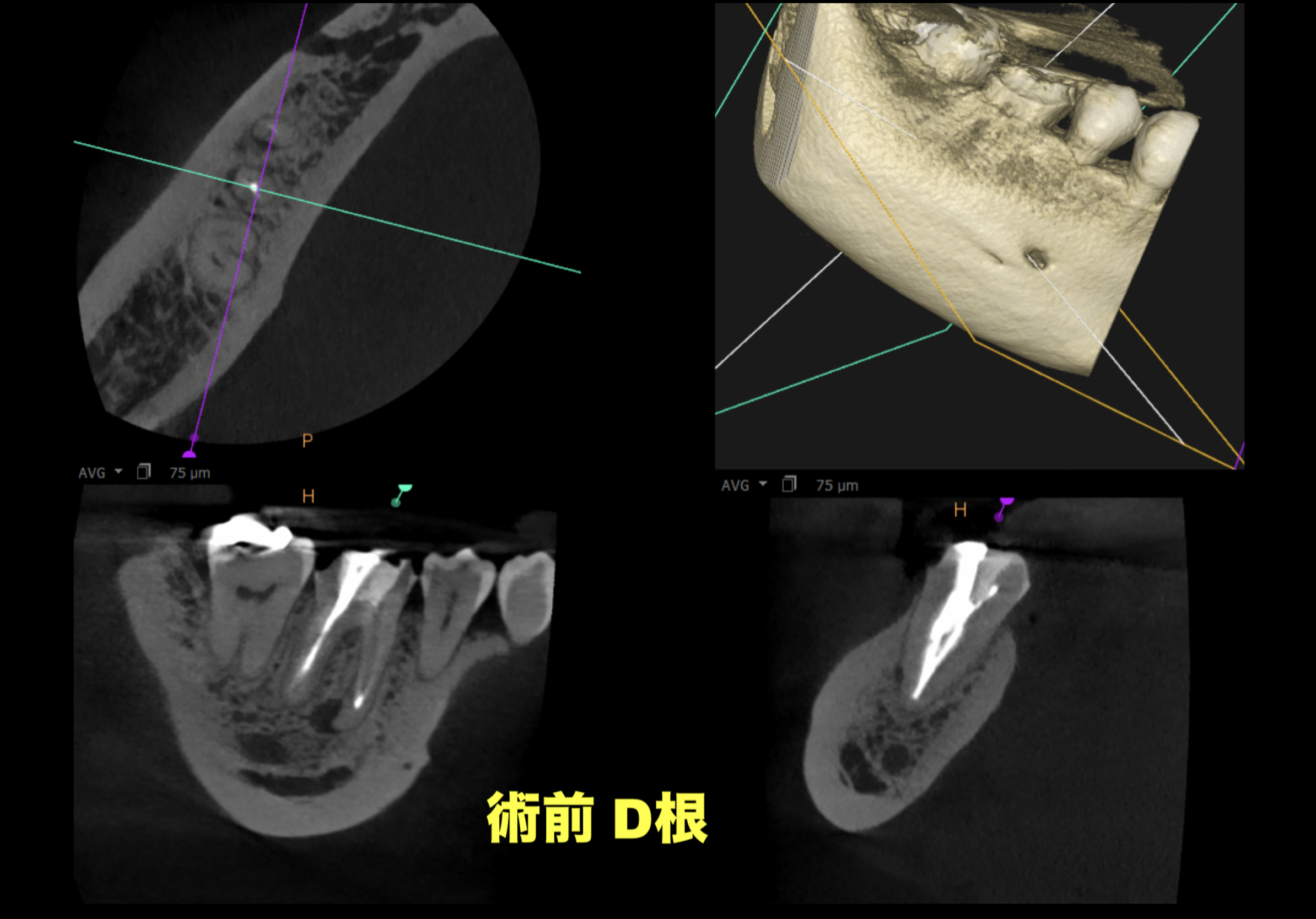 #30(右下6番) 再根管治療