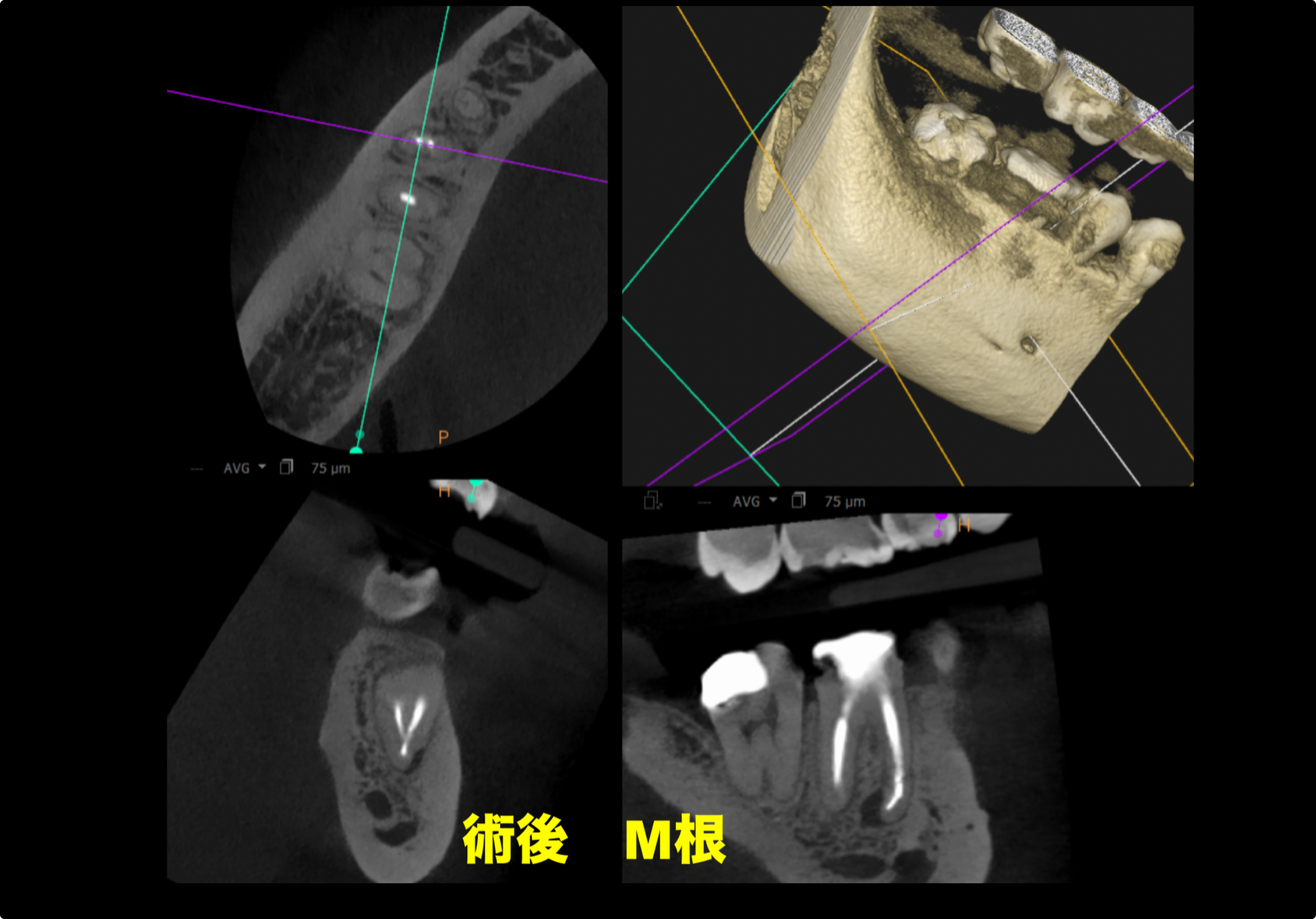 #30(右下6番) 再根管治療