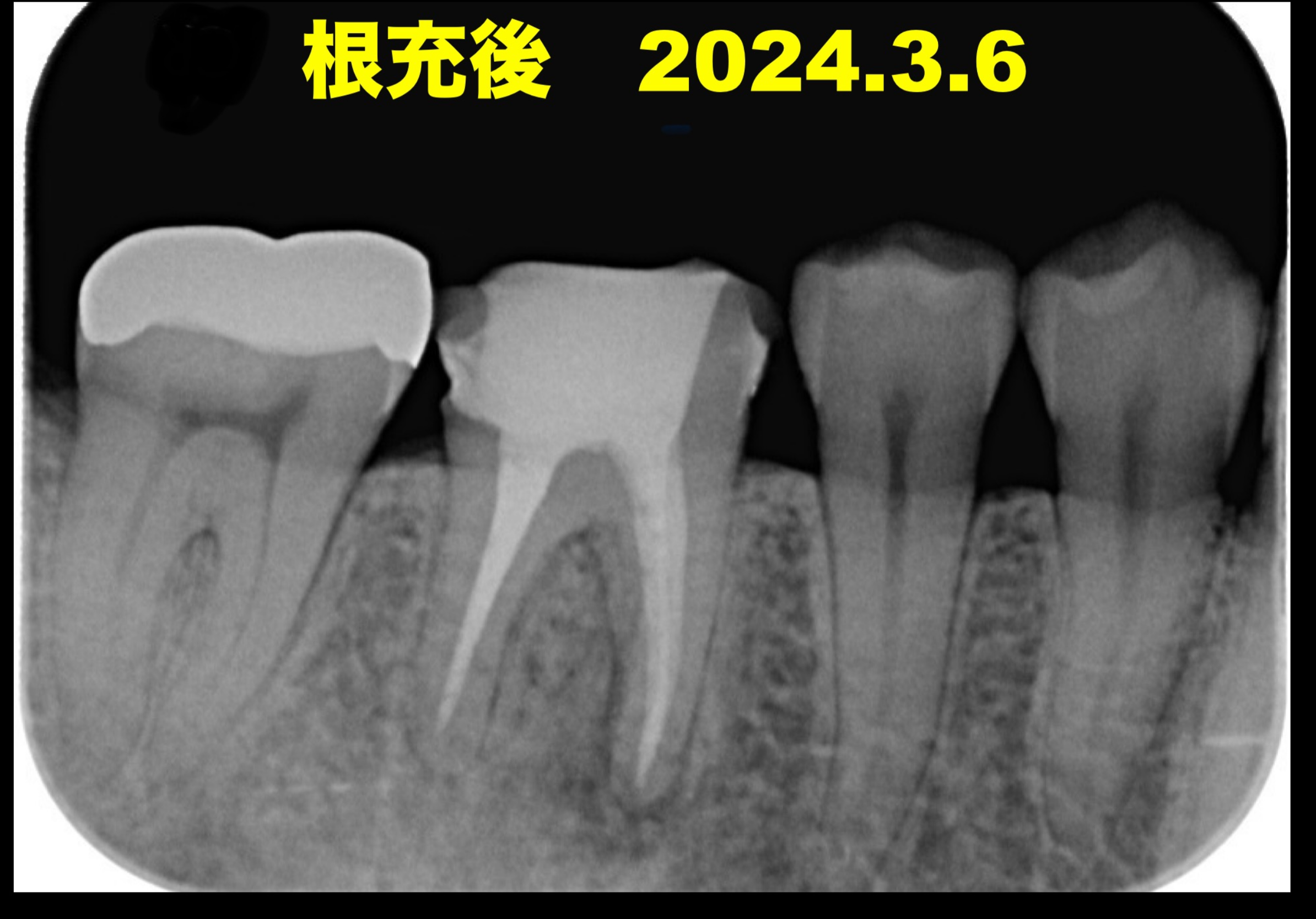 再根管治療6ヶ月予後