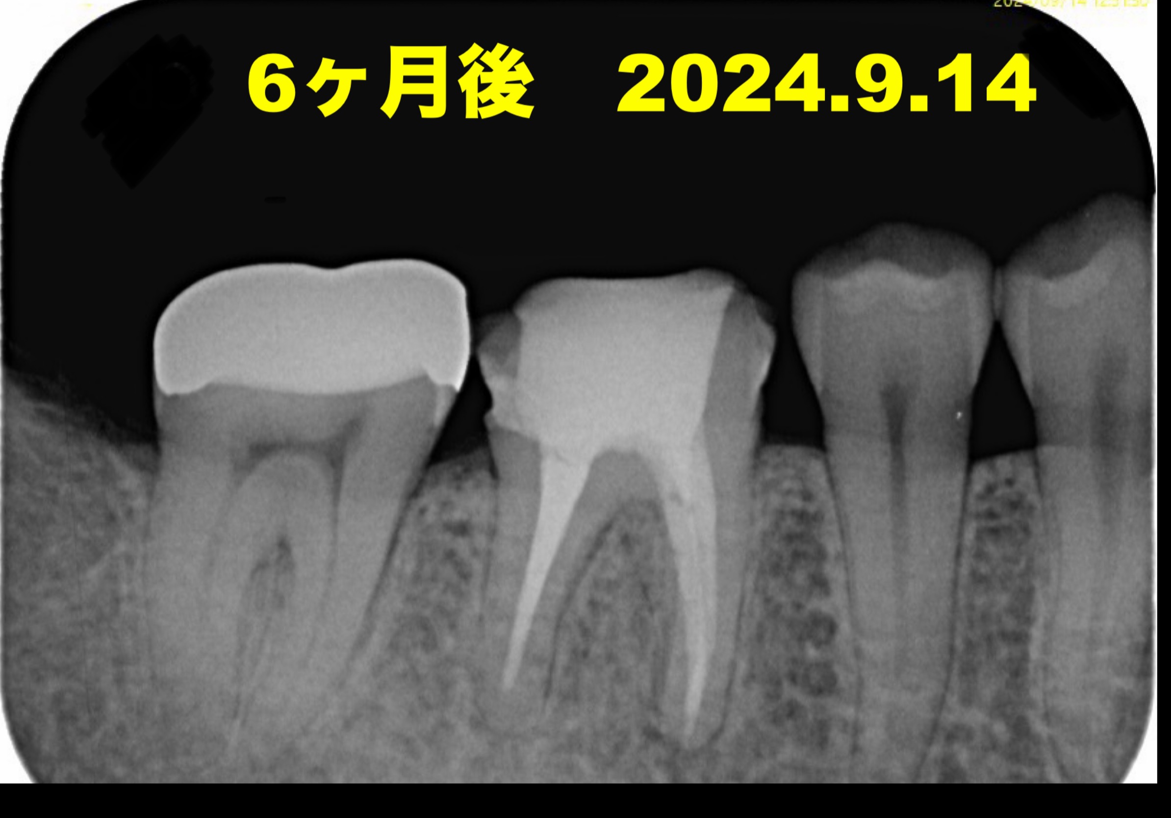 再根管治療6ヶ月予後