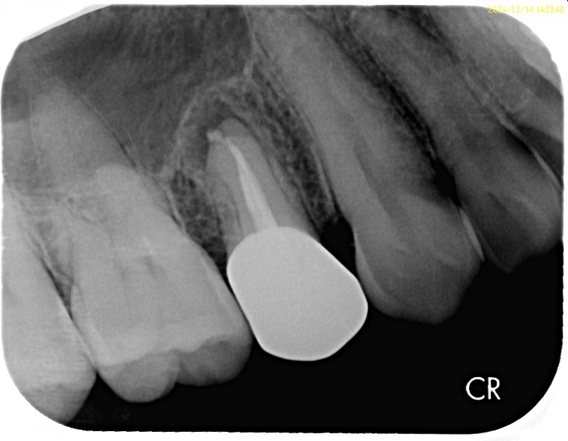 #５(右上４番) 再根管治療　　３ヶ月予後