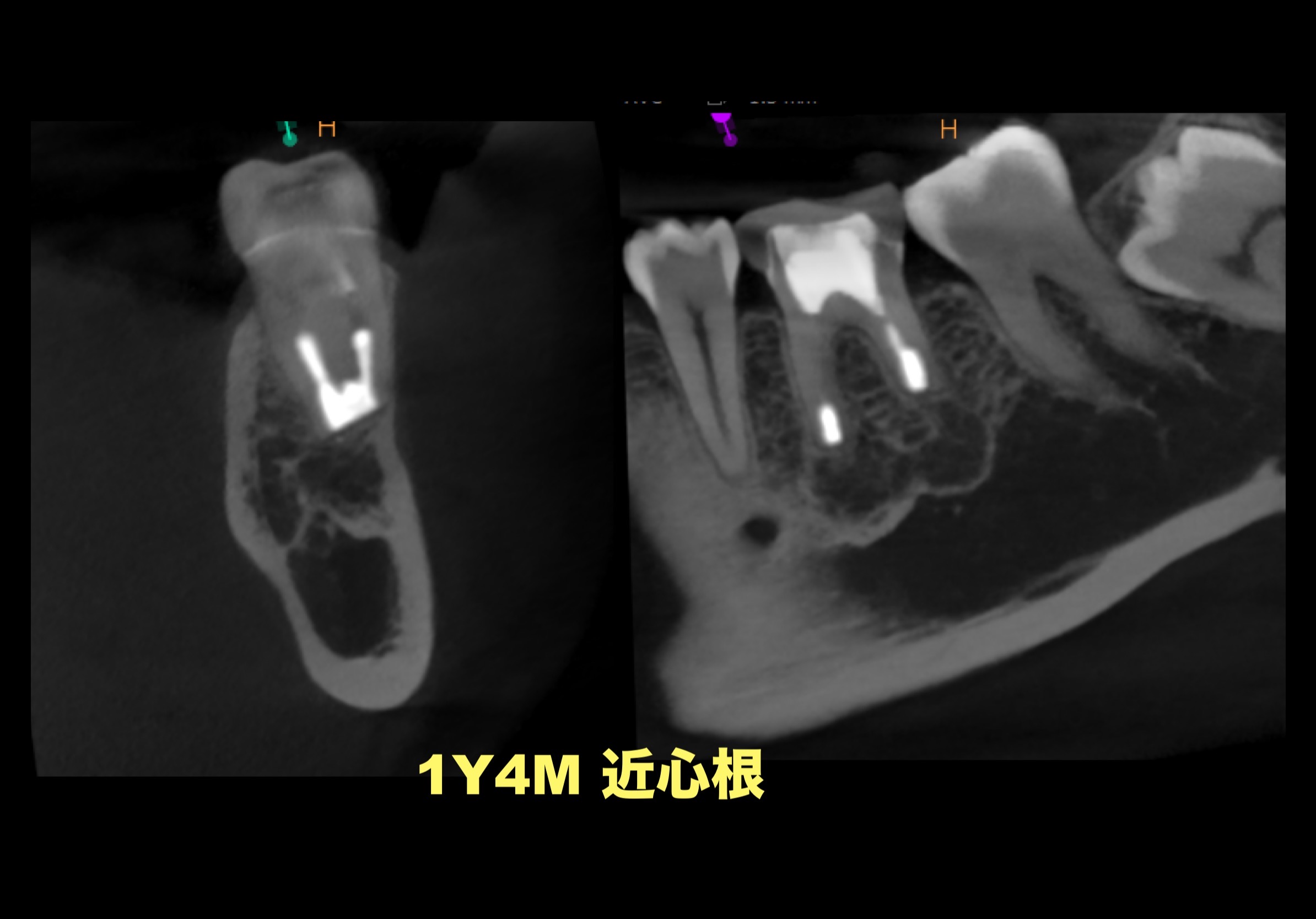 歯根端切除術（左下第一大臼歯）の症例