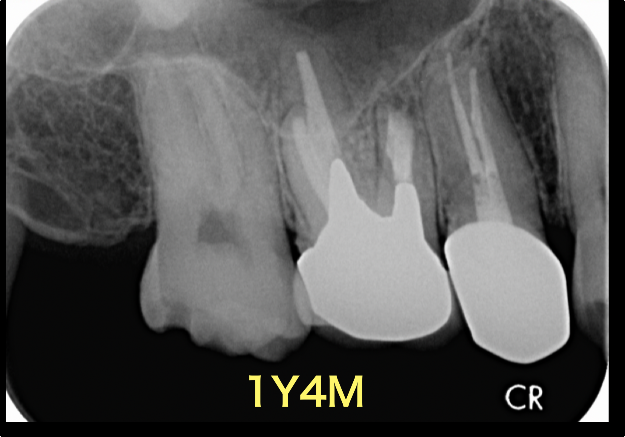 #3(右上6番)歯根端切除術の１年４ヶ月予後